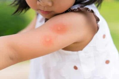 Difference Between Bed Bug Bites and Mosquito Bites