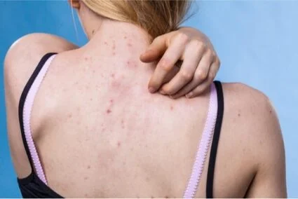 difference between acne and bed bug bites