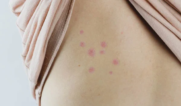 Bed bug bites or pimples